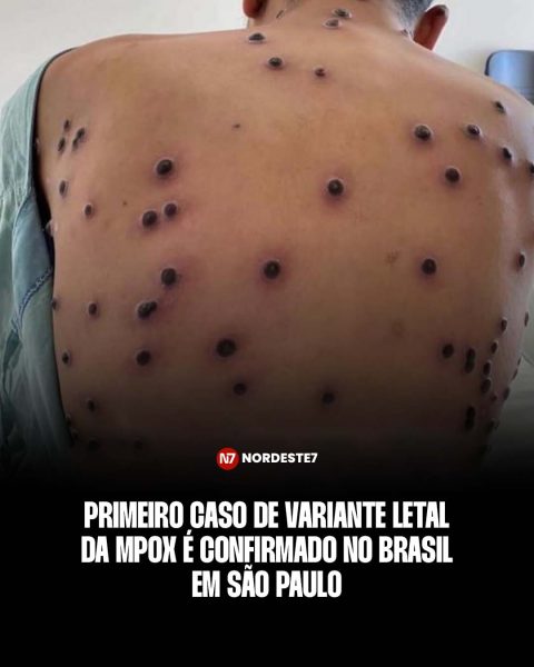 Primeiro caso de variante letal da mpox é confirmado no Brasil em São Paulo — Brasil. A variante letal chegou a São