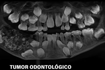 Cirurgia inédita retira 526 dentes da boca de menino de sete anos — Mundo. Criança apresentava inchaço mandibular e
