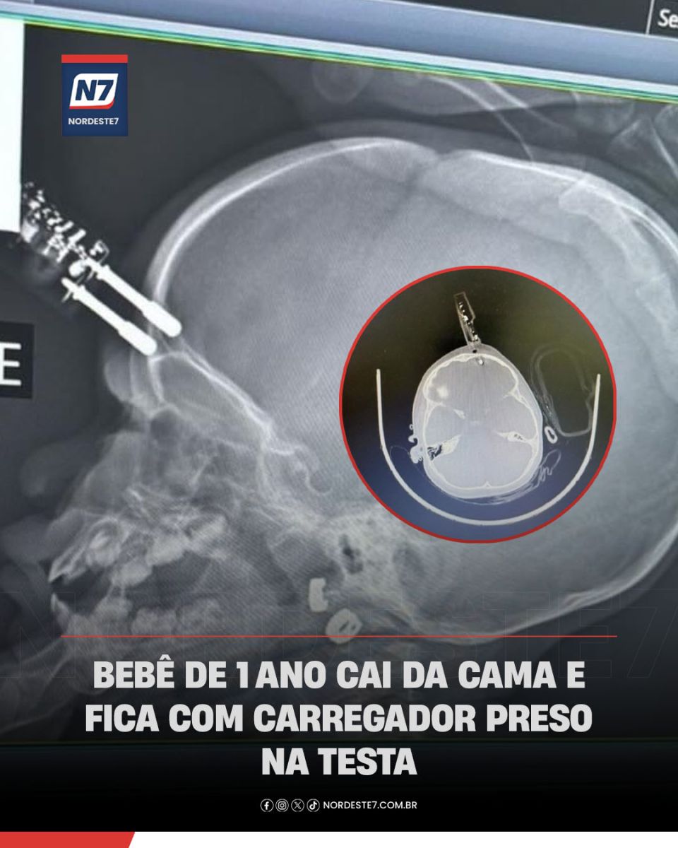Bebê de 1 ano cai da cama e fica com carregador preso na testa — Brasil. Objeto perfurou região frontal do crânio,